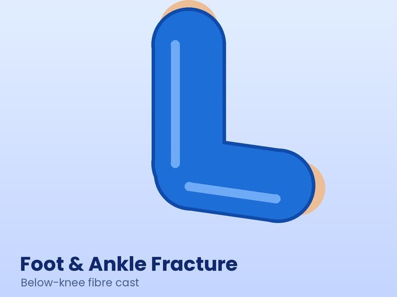 Illustration of a leg and foot with a blue below-knee fibre cast for ankle and foot fracture care