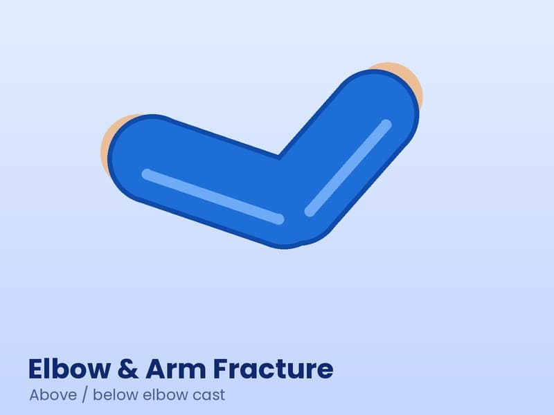 Illustration of an arm bent at the elbow with a blue fibre cast for elbow and arm fracture care