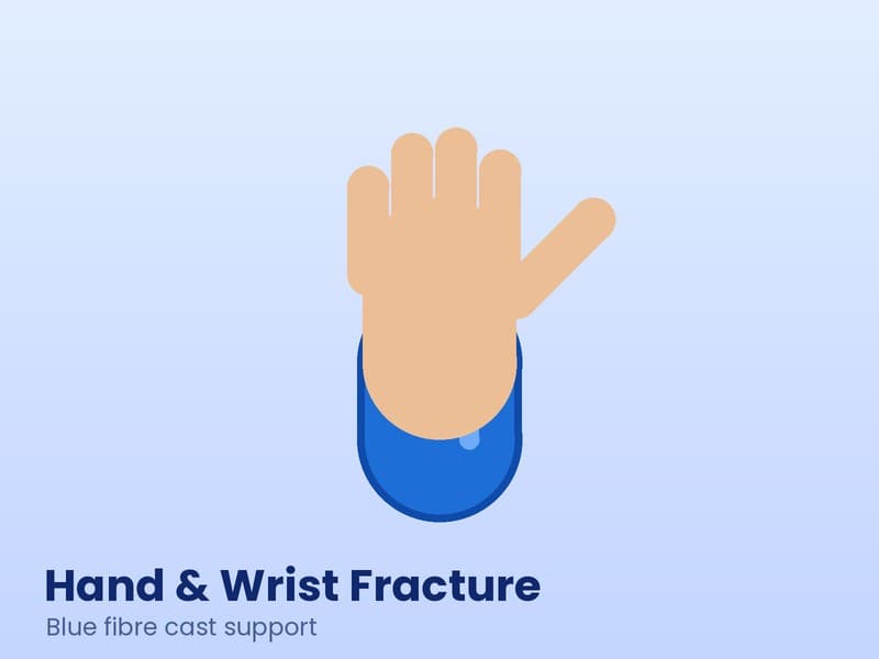 Illustration of a hand and wrist with a blue fibre cast for hand and wrist fracture care